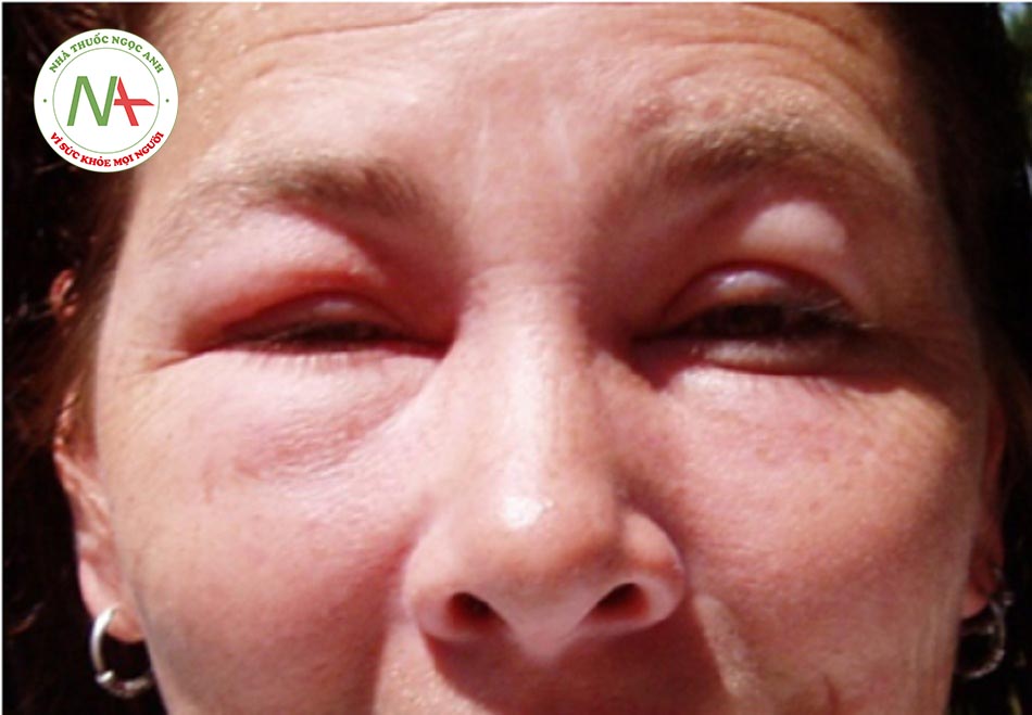Hình 11: Sưng quanh hốc mắt sau 24 giờ kể từ khi ong vàng đốt trên mắt phải 