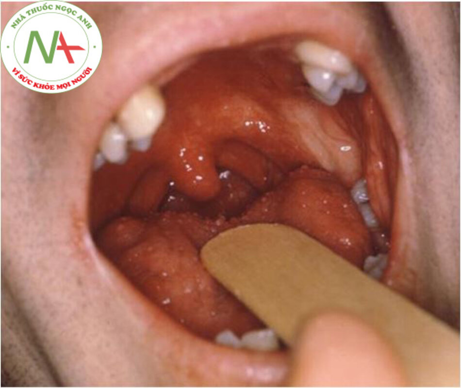 Hình 1: Mucosal ulcers in a patient with reactive arthritis.