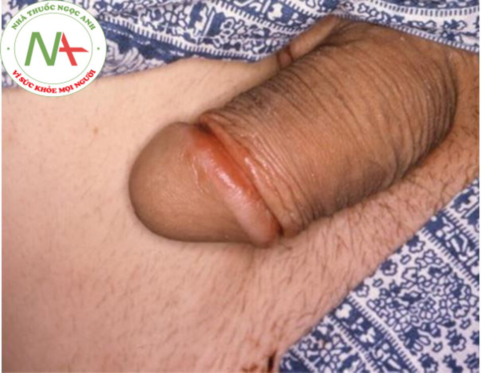 Hình 3: Balanitis in a patient with reactive arthritis.