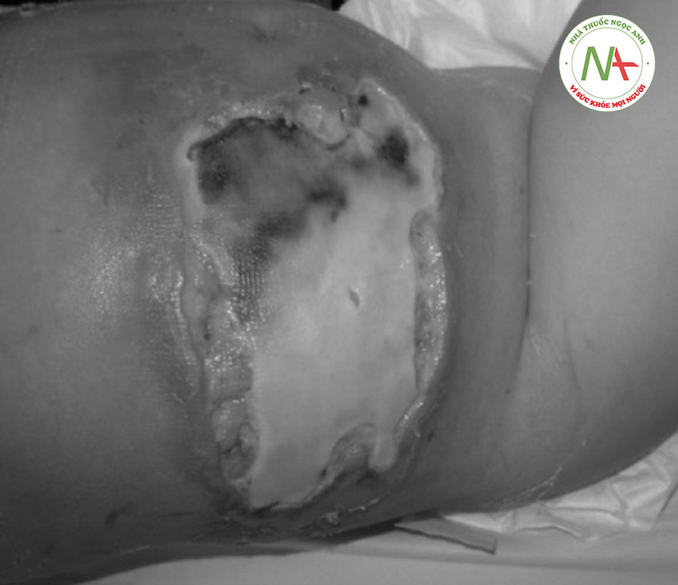 Hình 2: Viêm cân mạc hoại tử ở vùng bụng phải của bé gái 2 tuổi sau khi bị nhiễm vi-rút varicella zoster