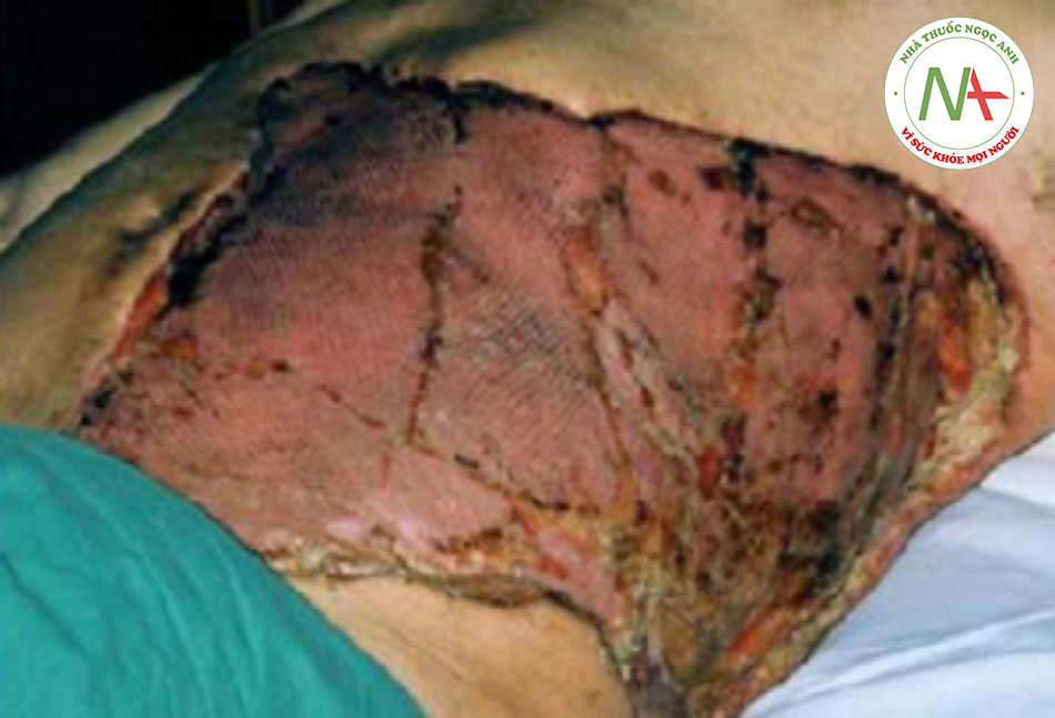 Hình 3: Các dấu hiệu muộn của viêm cân mạc hoại tử kèm viêm mô tế bào lan rộng, chai cứng, hoại tử da và hình thành bọng xuất huyết