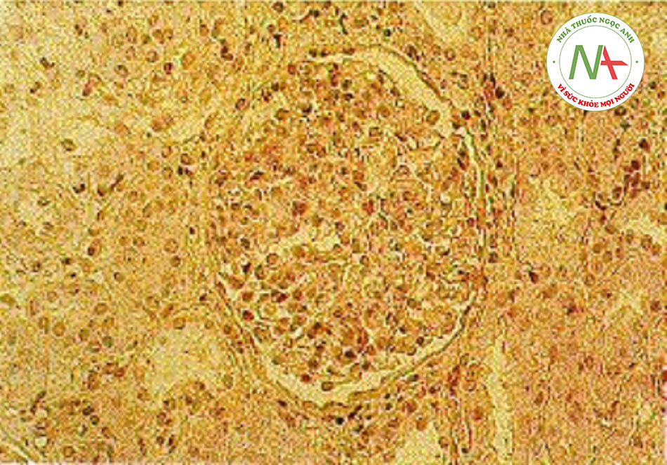 Hình 10: Viêm cầu thận tăng sinh lan tỏa, quan sát thấy ở viêm cầu thận hậu nhiễm liên cầu khuẩn