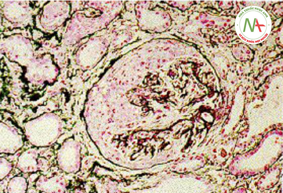 Hình 11: Viêm cầu thận liềm trong đó tế bào hình liềm chiếm phần lớn nang Bowman và chèn ép búi mạch cầu thận
