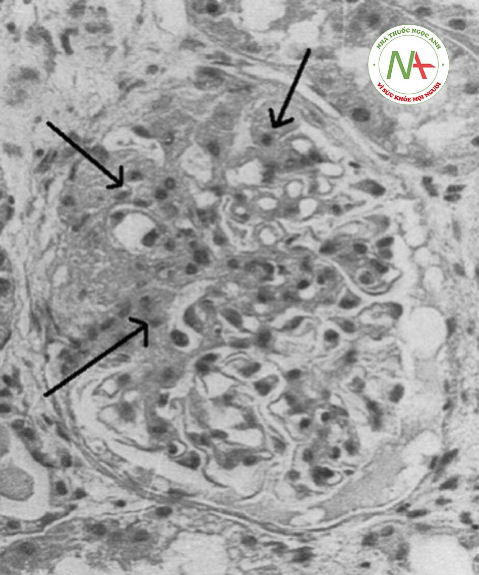 Hình 12: Kết quả quan sát mẫu sinh thiết thận dưới kính hiển vi quang học cho thấy những tổn thương điển hình của bệnh xơ hóa cầu thận khu trú từng phần (hướng mũi tên)