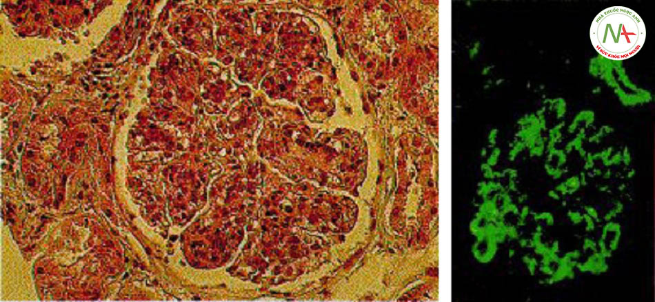 Hình 8: Viêm cầu thận tăng sinh màng cho thấy (bên trái) búi mao mạch dày lên và tăng sinh tế bào lan tỏa, tạo hình dạng 'tiểu thùy' đặc trưng (khi chụp hiển vi quang học; nhuộm: haematoxylin và eosin) và (bên phải) nhuộm miễn dịch huỳnh quang phát hiện IgM dạng hạt thô rải rác dọc mao mạch.
