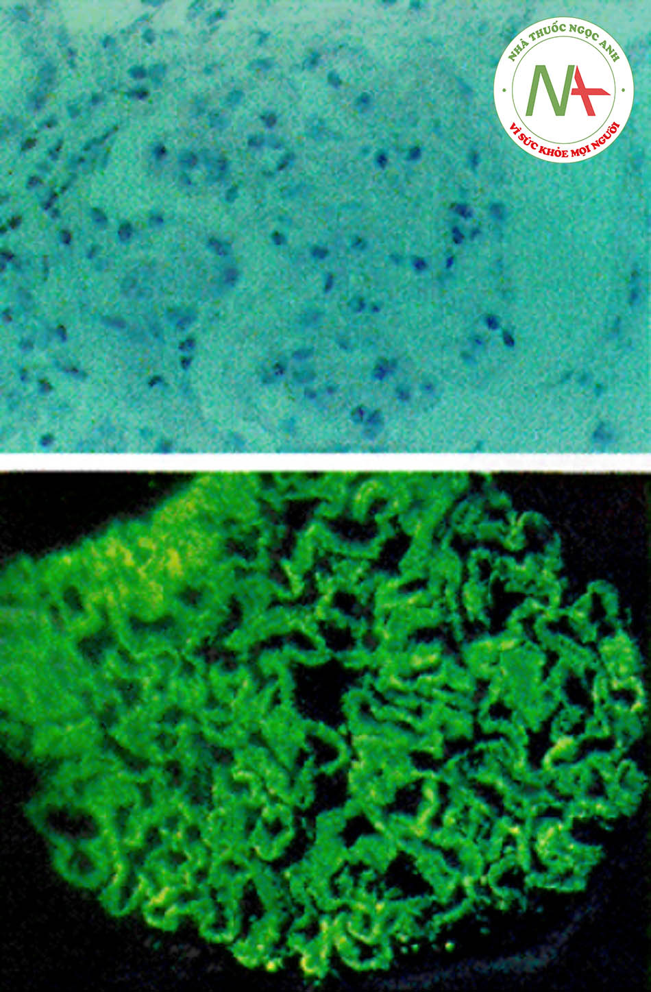 Hình 9: Bệnh cầu thận màng cho thấy màng đáy dày lên (trên), số lượng tế bào bình thường (khi chụp hiển vi quang học; nhuộm haematoxylin và eosin) và nhuộm miễn dịch huỳnh quang phát hiện IgG dạng hạt mịn (dưới) dọc màng đáy.