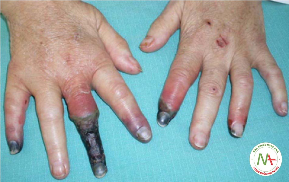 Hình 1: Ca bệnh hoại tử ngón bất thường do cryoglobulin liên quan đến viêm gan C gây ra