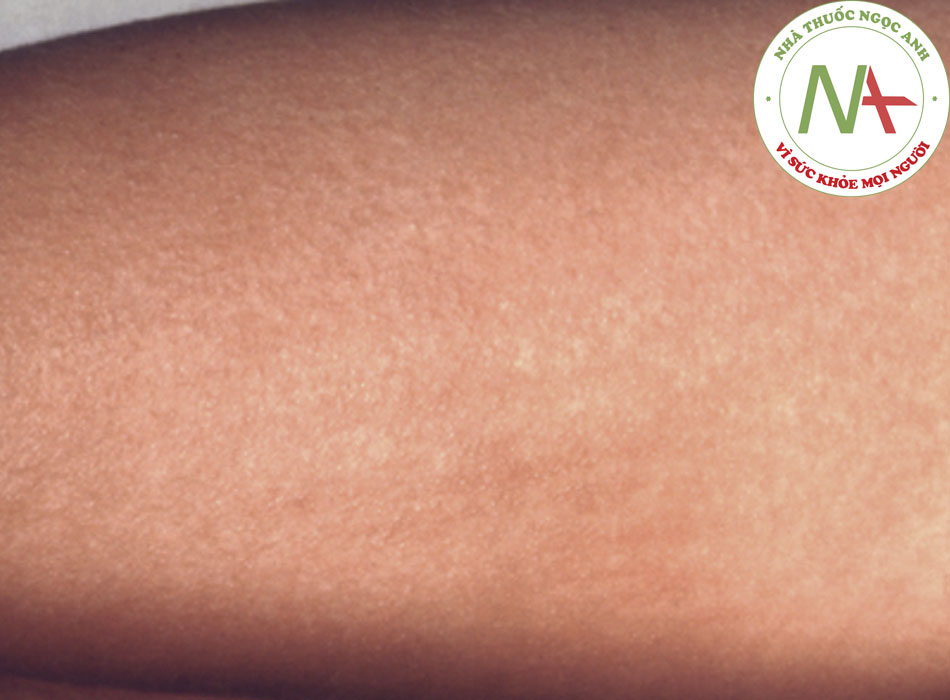 Hình 2: Phát ban sốt scarlet trên cánh tay do vi khuẩn liên cầu khuẩn nhóm A Hình ảnh từ Thư viện Hình ảnh Sức khỏe Cộng đồng của Trung tâm Kiểm soát Bệnh