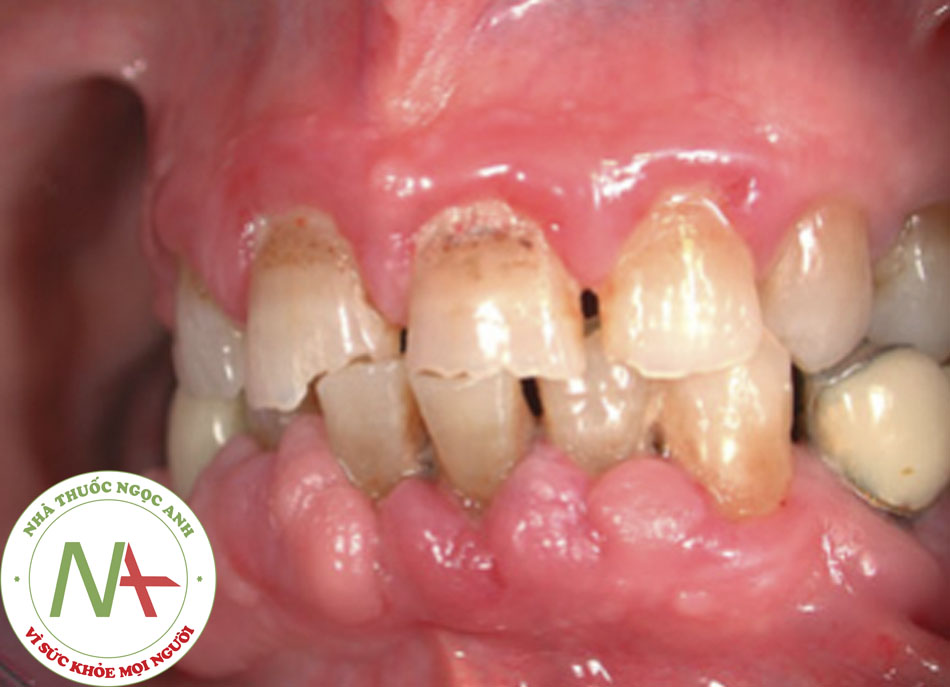 Hình 8: Lợi phì đại do dùng thuốc nifedipine Cũng có thể gây sâu răng cửa hàm trên Nguồn: Giuseppina Campisi, DDS, MS và Giuseppe Pizzo, DDS