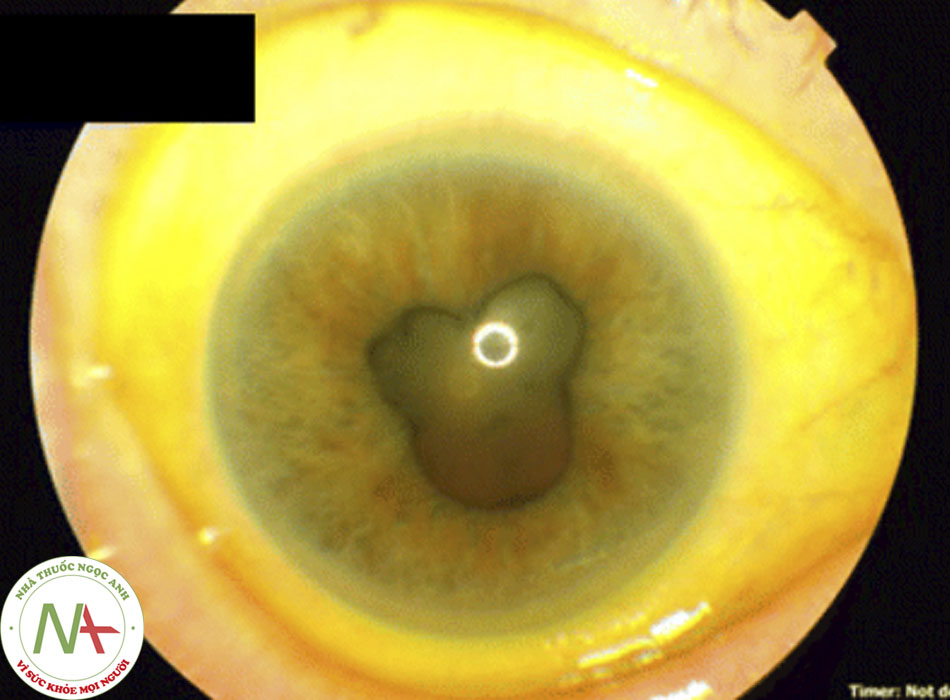 Hình 3: Dính sau (dính mống mắt với bao thủy tinh thể trước) ở bệnh nhân này có nguyên nhân từ viêm màng bồ đào Báo cáo Ca bệnh của BMJ năm 2012; doi:10.1136/bcr.12.2011.5418. Đã được phép sử dụng