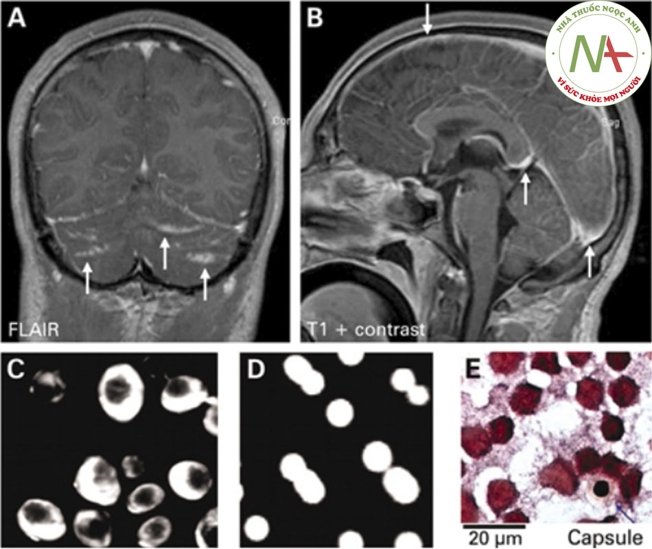 Hình 1: Cryptococcal meningoencephalitis. (A) Cranial MRI shows cerebellar hyperintensities (arrows) in FLAIR sequences (fluid-attenuated inversion recovery) and (B) meningeal contrast enhancement (arrows) in T1 weighted MRI. (C) Indian ink stain, (D) fungal culture, and (E) Gram stain of cerebrospinal fluid were positive Braun J. Headache, personality changes and fine motor disturbances. BMJ Case Reports. 2009; doi:10.1136/ bcr.06.2008.0093. Used with permission.