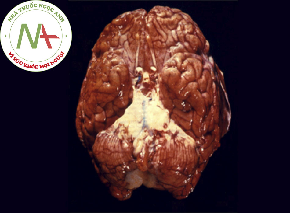 Hình 1: Hình não người, chụp từ mặt trước, minh họa tình trạng viêm màng não mủ nền sọ do phế cầu Hình ảnh do Thư viện Hình ảnh Y tế Cộng đồng thuộc Trung tâm Kiểm soát và Phòng ngừa Dịch bệnh Hoa Kỳ cũng cấp