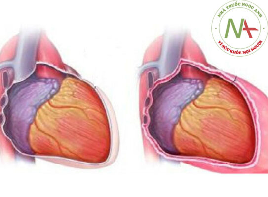 Viêm màng ngoài tim theo BMJ