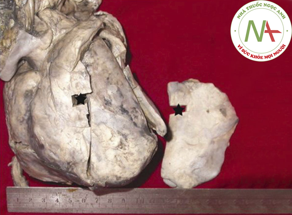 Hình 1: Viêm màng ngoài tim co thắt được xác định khi tử thiết; phần bên phải là mô sẹo cắt ra từ phía trước tim Xu JD, Cao XX, Liu XP, và cộng sự. Báo cáo Ca bệnh BMJ năm 2009; doi:10.1136/bcr.03.2009.1688