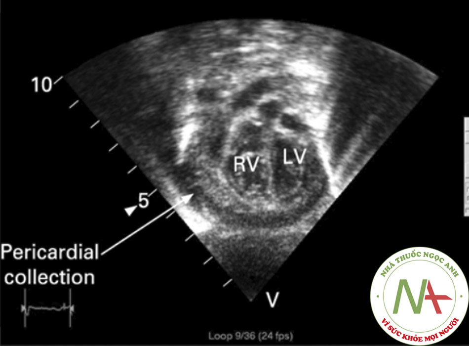 Hình 3: Siêu âm tim ở trẻ viêm màng ngoài tim có mủ, cho thấy tụ dịch màng ngoài tim. LV = tâm thất trái, RV = tâm thất phải Karuppaswamy V, Shauq A, Alphonso N. Báo cáo ca bệnh của BMJ năm 2009; doi:10.1136/bcr.2007.136564