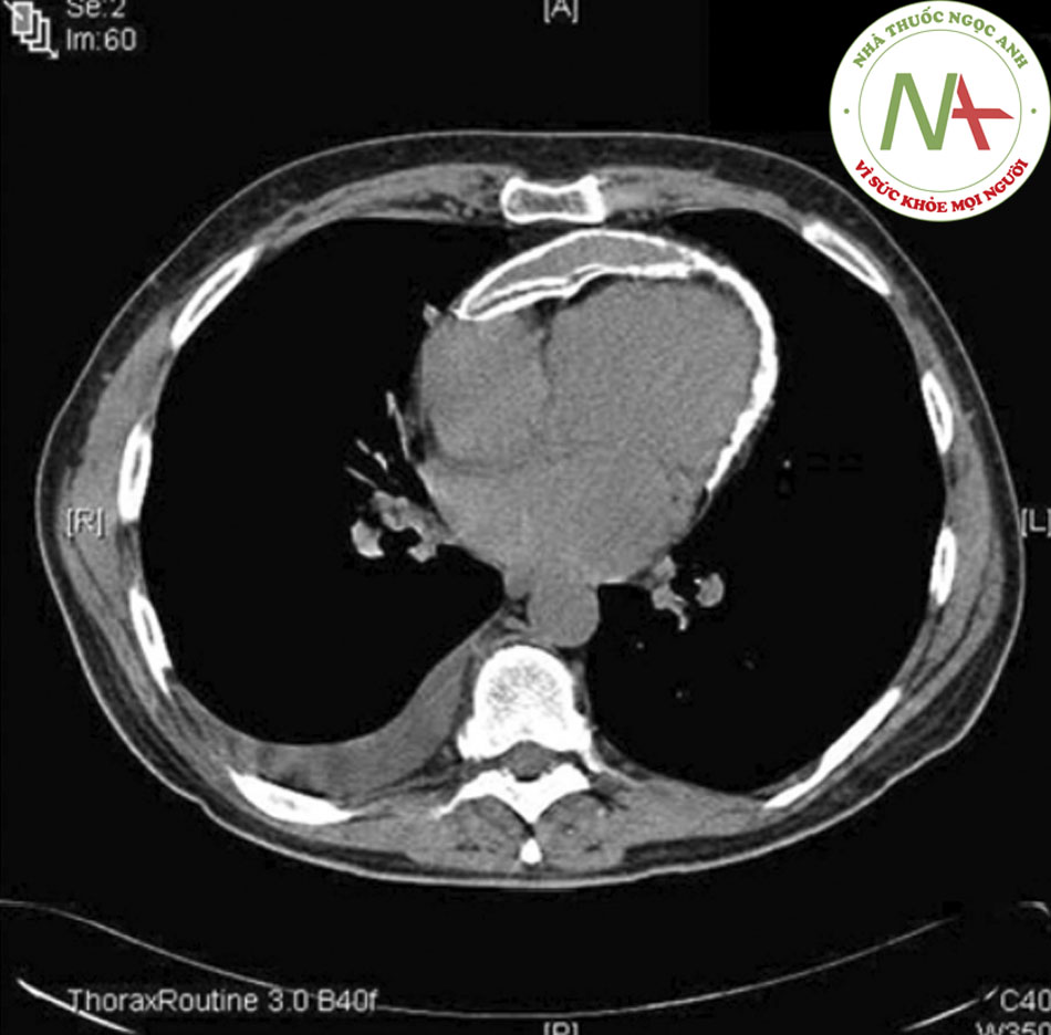 Hình 4: CT ngực cho thấy ha lớp màng ngoài tim vôi hóa ở bệnh nhân nam 56 tuổi bị viêm màng ngoài tim co thắt vôi hóa vô căn. Patanwala I, Crilley J, Trewby PN. Báo cáo ca bệnh của BMJ năm2009; doi:10.1136 /bcr.06.2008.0015