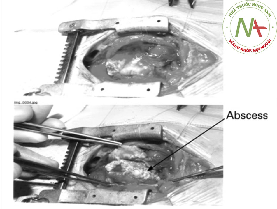 Hình 6: Mổ mở ở em bé viêm màng ngoài tim có mủ; áp-xe theo hướng mũi tên Karuppaswamy V, Shauq A, Alphonso N. Báo cáo ca bệnh của BMJ năm 2009; doi:10.1136/bcr.2007.136564