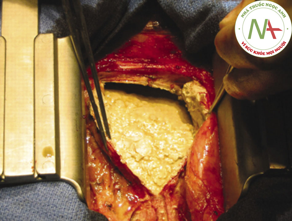 Hình 7: Phẫu thuật mở màng ngoài tim ở bệnh nhân nam 56 tuổi bị viêm màng ngoài tim co thắt vôi hóa vô căn. Màng ngoài tim bị dày lên và vôi hóa Patanwala I, Crilley J, Trewby PN. Báo cáo ca bệnh của BMJ năm2009; doi:10.1136 /bcr.06.2008.0015