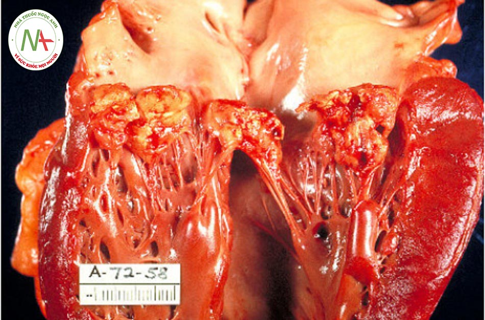 Hình 1: Hình ảnh đại thể của viêm nội tâm mạc bán cấp do vi khuẩn gây tổn thương van hai lá