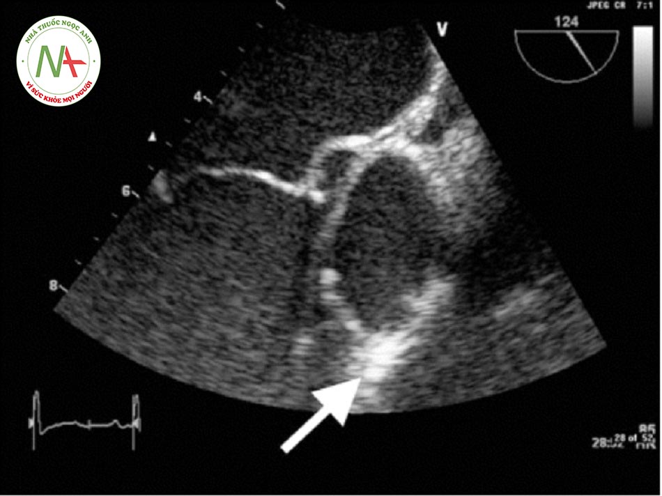 Hình 4: Hình ảnh siêu âm tim qua thực quản. Mũi tên màu trắng chính là sùi trên van động mạch chủ của bệnh nhân