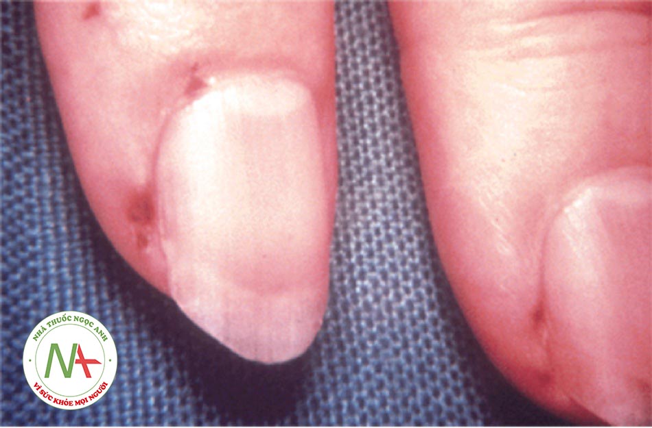 Hình 7: Nhồi máu vùng da