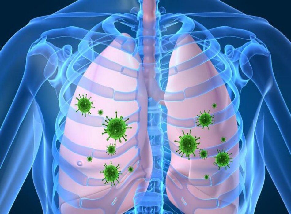 Viêm phổi do nhiễm Pneumocystis jirovecii