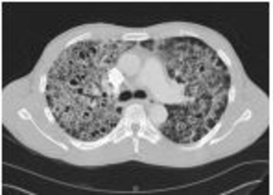 Hình 2: Chụp CT ngực cho thấy thâm nhiễm mô kẽ phổi hai bên và các túi khí có thành mỏng (nang), là điển hình của viêm phổi do nhiễm nấm Pneumocystis (PCP)