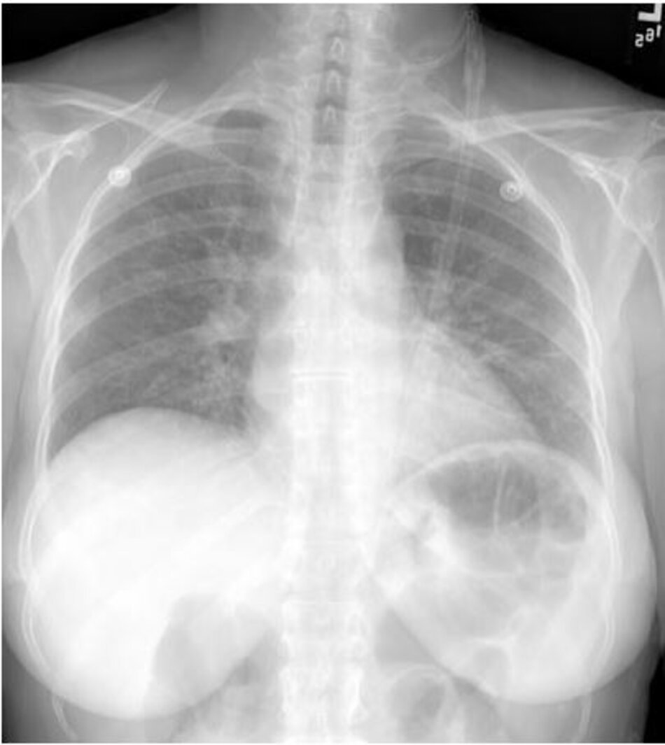 Hình 3: X-quang ngực thẳng (tư thế sau-trước) cho thấy hình ảnh thâm nhiễm mô kẽ phổi nhẹ hai bên, dạng lưới. 