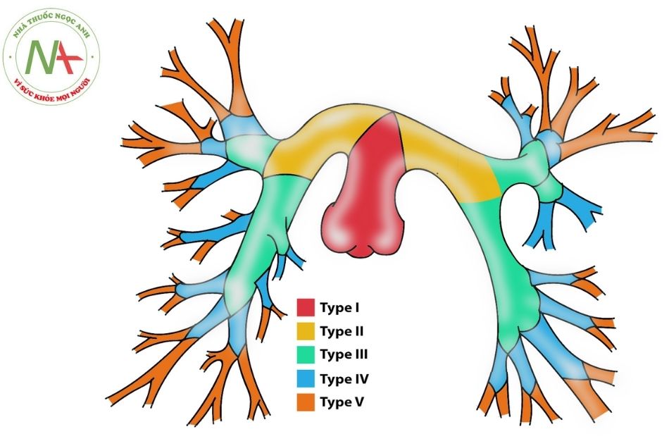 Hình 1. Phân loại 5 type hẹp động mạch phổi