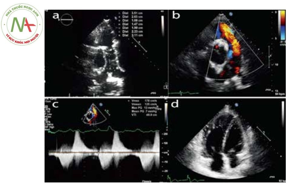 Hình 1. Hình ảnh siêu âm tim qua thành ngực ở bệnh nhân rối loạn chức năng van homograft động mạch phổi