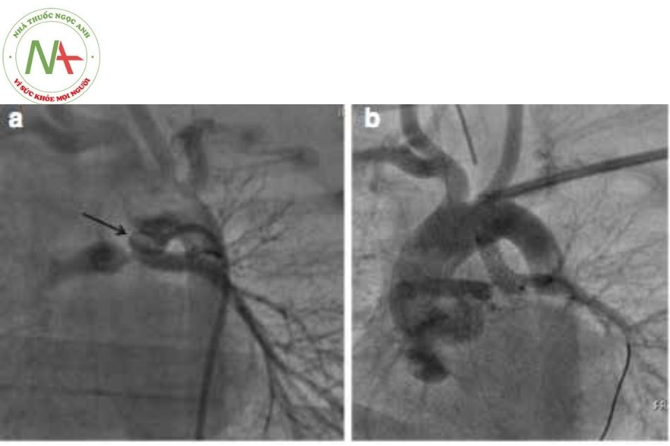 Hình 14. (a) Ống thông từ động mạch đùi chụp ống động mạch type III (mũi tên); (b) Cần tiếp cận từ cận động mạch nách để đặt một stent mạch vành 4 mm, lưu ý đầu dây dẫn ở vị trí thuỳ dưới phổi trái.