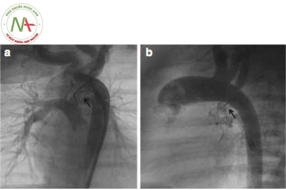 Hình 15. (a) Hình ảnh stent (mũi tên) ống động mạch typ III từ mặt dưới quai động mạch chủ ở bệnh nhân chuyển gốc đại động mạch, thông liên thất lớn, teo tịt van động mạch phổi. (b) Sau khi rút dây dẫn, thấy huyết khối gây tắc stent hoàn toàn.