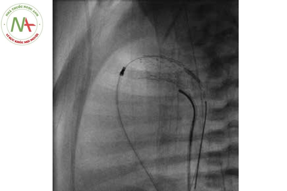 Hình 18. Góc bên, nghiêng bóng 90 độ, quan sát stent được đặt trong ống động mạch