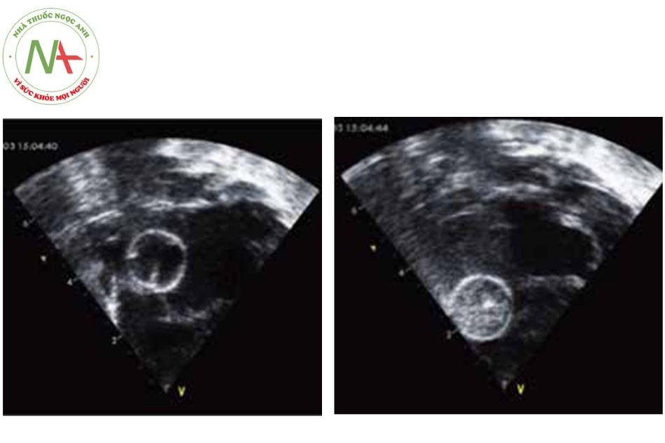 Hình 2. Hình ảnh làm thủ thuật Rashkin dưới hướng dẫn siêu âm tim với mặt cắt dưới mũi ức