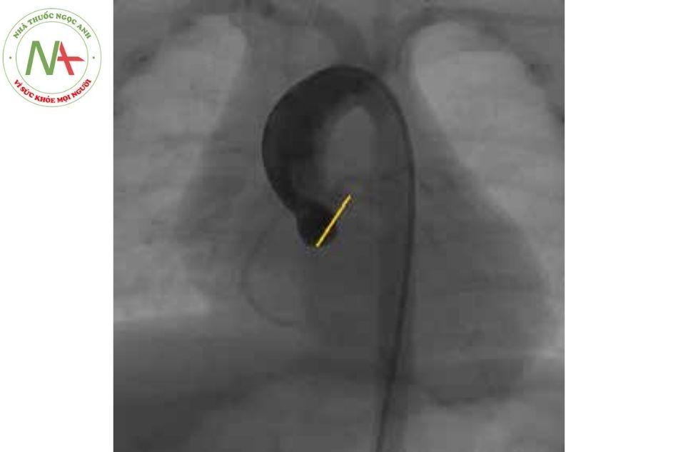 Hình 3A. Chụp gốc động mạch chủ (góc thẳng mặt) và đo đường kính vòng van động mạch chủ qua hình ảnh chụp mạch