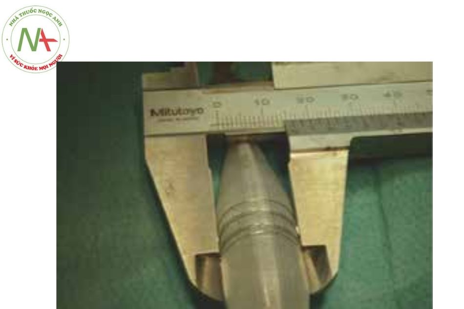 Hình 4. Stent 535 Cook Formula 8 x 12 mm được nở ra đến 14 mm do được nong bằng bóng áp lực cao lên đến 16 mm. Một mắt nối của stent bị vỡ