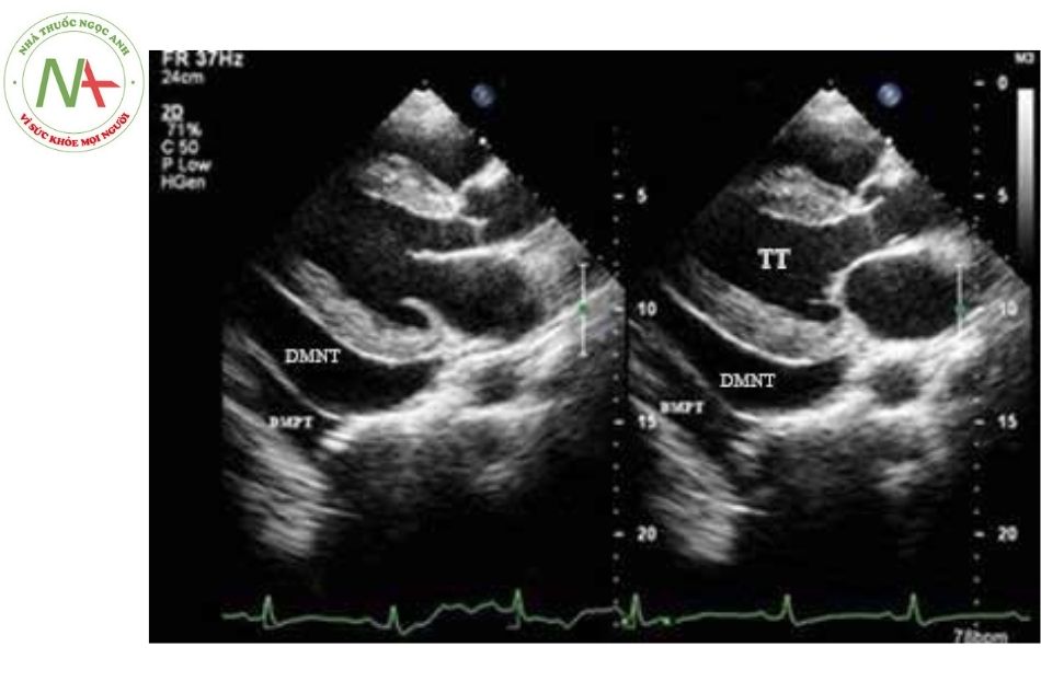 Hình 4. Tràn dịch màng tim ở mặt cắt cạnh ức trục dài trên siêu âm tim qua thành ngực