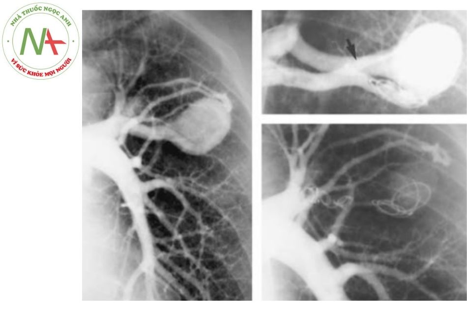 Hình 8. Chụp chọn lọc động mạch phổi trái cho thấy hình ảnh một động mạch nuôi duy nhất. Hình ảnh chụp mạch chọn lọc thể hiện hình ảnh rõ ràng của dị dạng thông động tĩnh mạch phổi với nhiều coil bên trong, những coil này nằm ngay cạnh một nhánh động mạch nhỏ tưới máu cho phần nhu mô phổi bình thường (mũi tên màu đen)