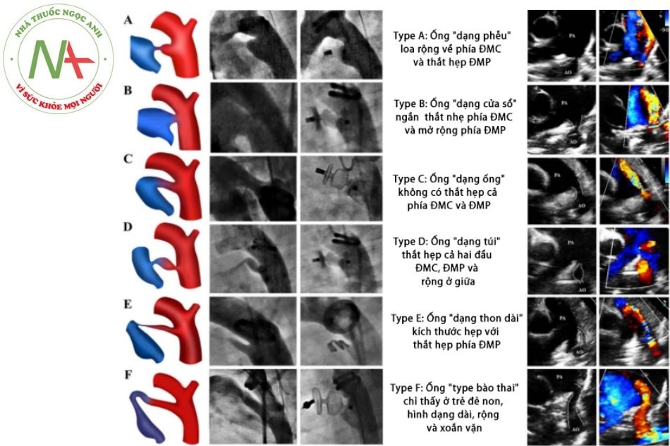 Hình 2. Phân loại các type ống động mạch (trên siêu âm tim, chụp mạch và hình minh họa)