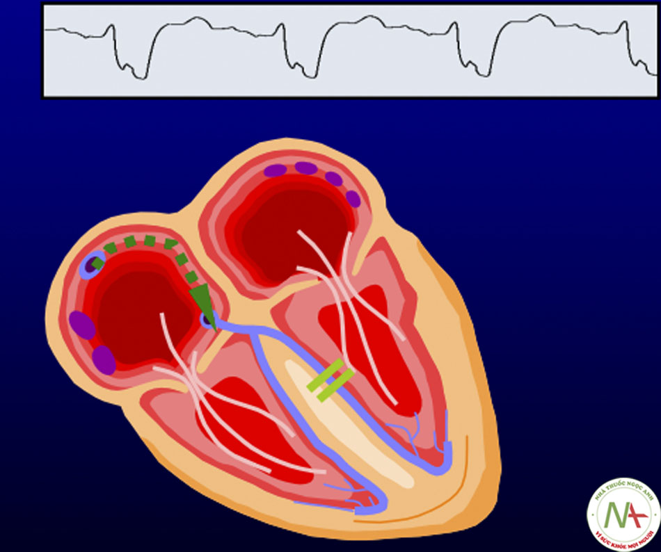 Cơ sở của máy tạo nhịp tái đồng bộ tim