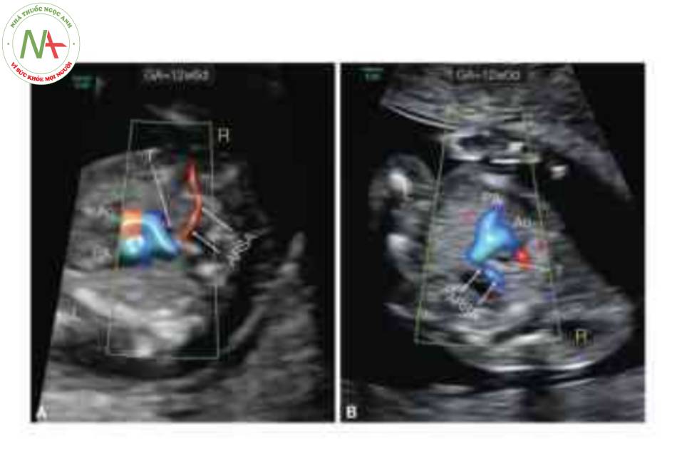 Động mạch dưới đòn phải lạc chỗ (ARSA) ở hai thai nhi (A, B) 12 tuần tuổi được ghi nhận trong khi đo độ mờ da gáy từ hai góc tới khác nhau