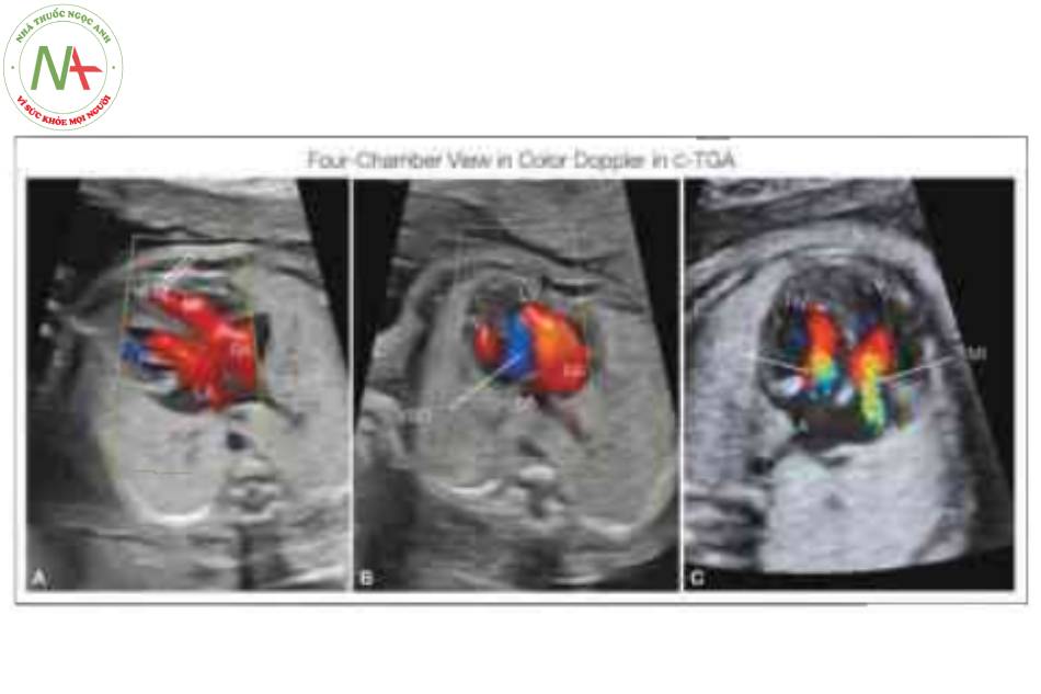 Hình 12: Doppler màu trong mặt cắt bốn buồng ở ba thai nhi với chuyển vị đại động mạch có sửa chữa
