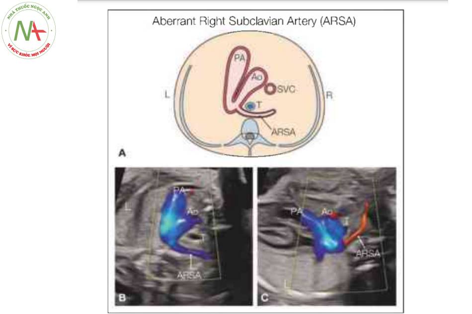 Hình vẽ giản đồ của mặt cắt ba mạch máu-khí quản (A) và hình ảnh siêu âm tương ứng trong Doppler màu (B, C) ở hai thai nhi có động mạch dưới đòn phải lạc chồ (ARSA).