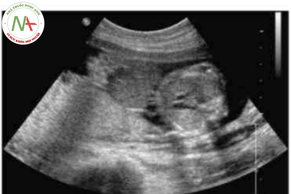 Hình 10 Có khá năng khối thoắt vi rốn đã vỡ ở thai nhi 23 tuần tuổi