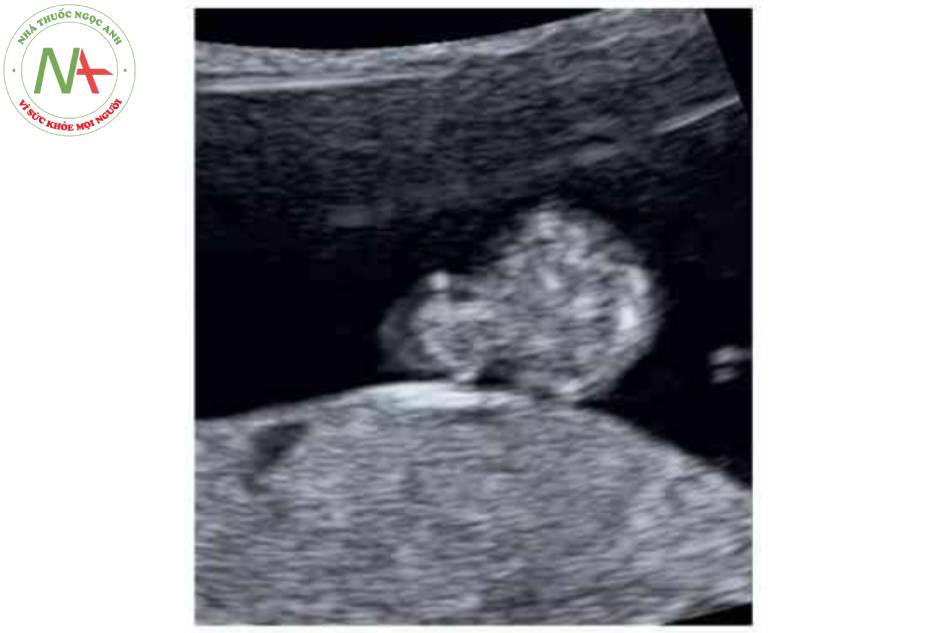 Hình 10. Thoát vị ruột sinh lý. Mặt cắt ngang thai nhi 11 tuần tuồi cho thấy các tạng trong ổ bụng thoát vị đáng kể (mũi tên), liên quan đến khe hờ thành bụng