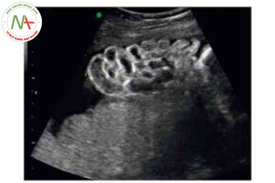 Hình 11 Ruột nổi tự do được thấy trong trường hợp khối thoát vị rốn đã võ ớ thai nhi 32 tuần tuổi.
