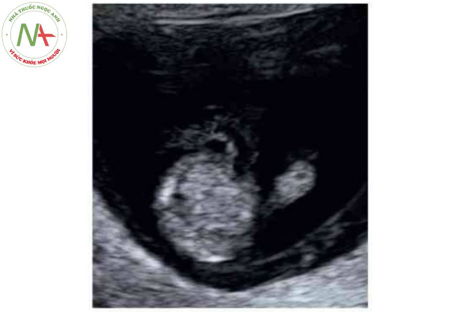 Hình 11. Thoát vị ruột sinh lý đã thoái triển hoàn toàn. Mặt cắt ngang thai nhi 13 tuần tuổi cho thấy thoát vị ruột sinh lý đà thoái triển hoàn toàn ở vị trí dây rốn cắm vào (mũi tên)