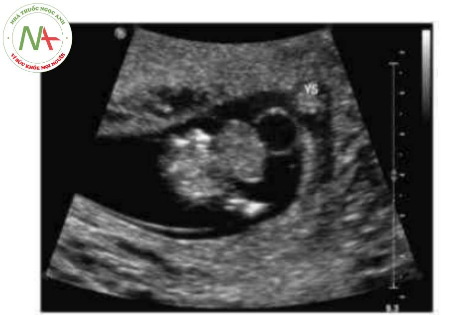 Hình 13 Thoát vị rốn lớn được thấy ở thai nhi 11 tuần tuổi; lưu ỷ sự hiện diện của túi noãn hoàng