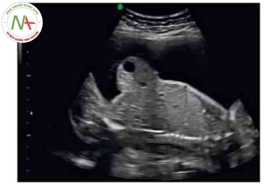Hình 2 Thoát vị rốn với gan ngoài cơ thể được thấy ở mặt cắt dọc lúc thai 21 tuần tuổi