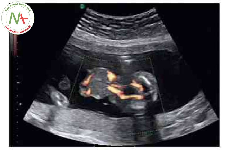 Hình 3 Các mạch máu dây rốn chạy qua khối thoát vị rốn của thai nhi được thấy ớ mặt cắt ngang lúc thai 19 tuần tuổi